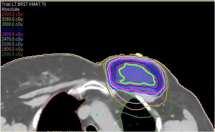 to_be_elizabeth's tweet photo. 📌 Ultra-Hypofractionated Partial Breast Re-Irradiation for Ipsilateral Breast Tumor Recurrence
🔗 https://t.co/vMpLq7symH
@OncoAlert #OncoAlertAF @Advances_ASTRO 
👉🏻 This study evaluates the safety and feasibility of ultra-hypofractionated PBrI following repeat lumpectomy.
👤25 women
☢️ 26Gy in 5 fx 
🗓️median interval of 16.6 years from initial treatment
👉🏻  median follow-up of 13 months after PBIrI ➡️ local control rate of 96%
👉🏻acceptable cosmetic outcomes and short-term cancer control in appropriately selected patients