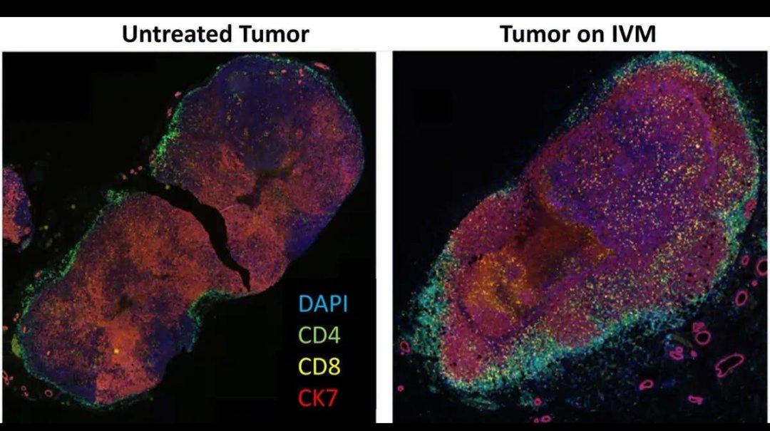 ZakariaMDv3's tweet photo. 🚨 JUST IN: Major Ivermectin Cancer Study Published in Anticancer Research

Look closely at these two images.

At first glance...

They look remarkably similar.

But that's not what caught the researchers' attention.

❌ On the left is an untreated tumor.

✅ On the right is a tumor from a patient receiving Ivermectin (IVM). 

The difference wasn't simply the tumor itself.

It was what was happening inside it.

According to the study, the Ivermectin-treated tumor showed greater infiltration of CD4+ and CD8+ immune cells, suggesting a more active immune response within the tumor microenvironment.

Then I got to the study's findings.

Researchers published a new study in Anticancer Research evaluating a treatment approach that included repurposed medicines such as Ivermectin for patients with advanced cancer.

According to the authors, many participants experienced meaningful clinical responses, with some achieving complete remissions or substantial tumor regression during the study period.

📌 The research was led by physicians including Dr. Paul Marik, Dr. Ilyes Baghli, and Dr. Pierrick Martinez, who continue to investigate the potential role of repurposed medicines in oncology.

The authors note that larger, controlled clinical trials are still needed to better understand these findings and determine how they may translate into broader clinical practice.

Even so, studies like this continue to expand the scientific discussion around repurposed medicines.

More published research.

More physicians exploring new ideas.

More patients searching for answers.

More interest in repurposed medicines than ever before.

One study isn't the final answer.

But every published study adds another piece to the scientific puzzle.

And the conversation around repurposed medicines continues to grow.

🔁 Share this post with anyone following developments in cancer research and repurposed medicines.

Do you want to see more of this? Follow me.