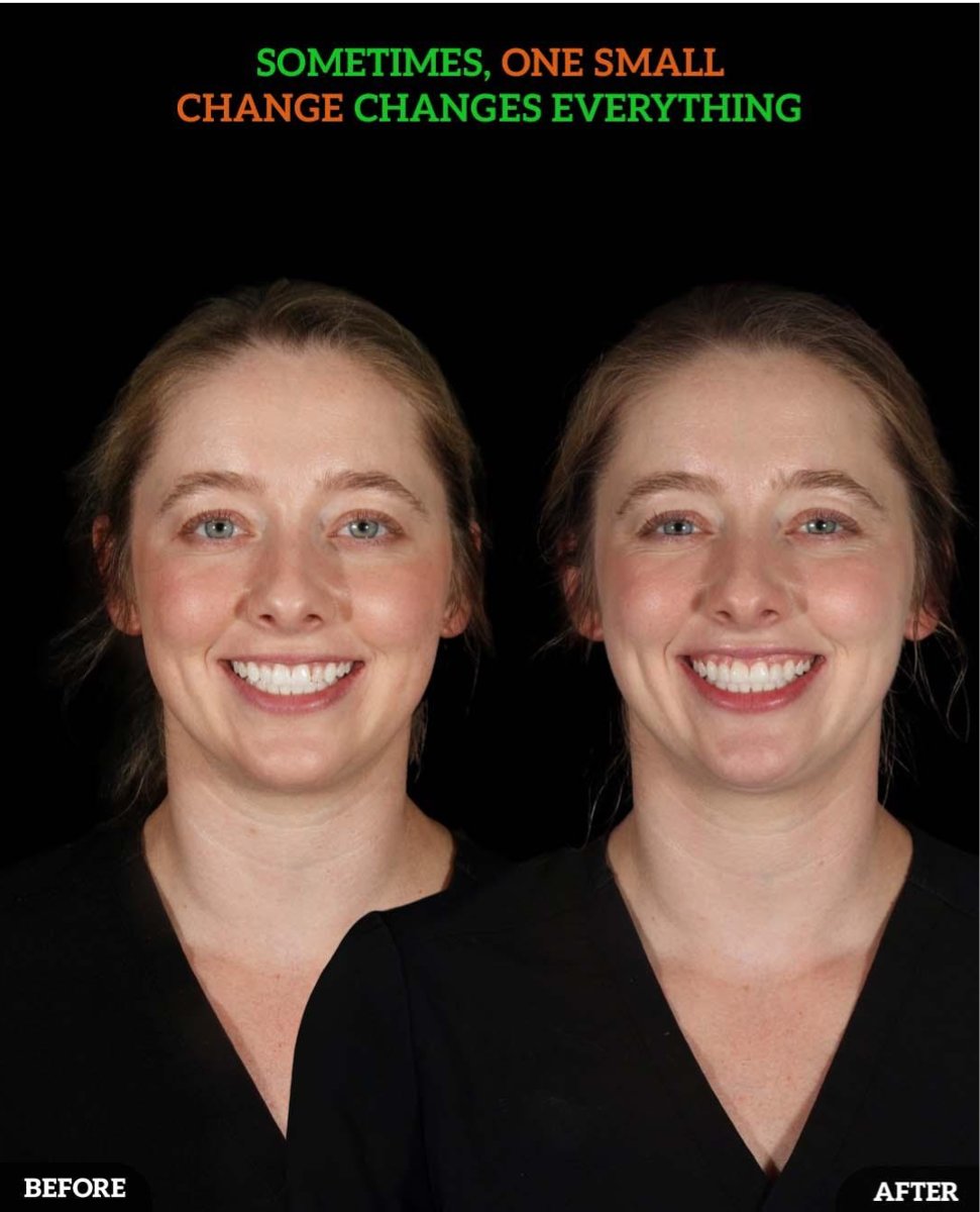 DMDGroup's tweet photo. Jessica’s Smile Transformation | Single Veneer Magic | Fixing One Tooth for a Whole New Look
✨ What We Corrected:
• One short, uneven tooth
• Localized staining/discoloration

📞 (614) MY-SMILE
🌐 https://t.co/cTIepI3ioF https://t.co/pa46VbOAoH