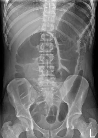 drkeithsiau's tweet photo. X-ray of a 20 year old with a 3-day history of diarrhoea and abdominal pain. What’s the most likely diagnosis here? https://t.co/c0oneCSNKy