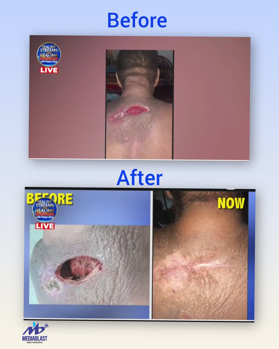 mediablastnet's tweet photo. What started as a tiny scratch turned into skin cancer and a painful ulcer... but that's not how the story ended. 🙌

Today, he's completely healed! Thank God for Pastor Chris. Thank God for the Healing to the Nations Magazine 

Your miracle could be next.

Connect now to the Healing Streams Live Healing Services with Pastor Chris and expect a divine touch.

Showing now on:
👉 https://t.co/H7RnQxDVMT

👍 Like | 💬 Comment | 🔁 Share

#MediablastNetwork
#LMM
#LFAD #VPR