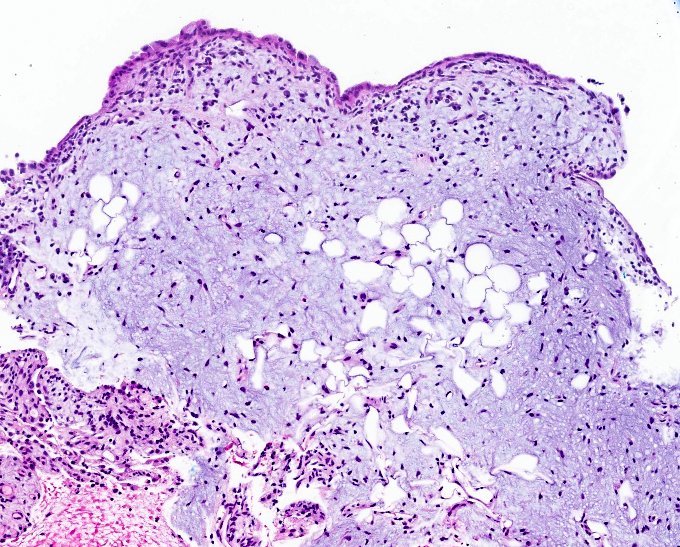 Saroja_DeviG's tweet photo. This cute little lesion was biopsied from the lung. ๐ซ
What is your diagnosis? ๐ฌ
#PathTwitter #MedTwitter #PulmPath #PulmPathFellow https://t.co/tvRnZ4Po1X