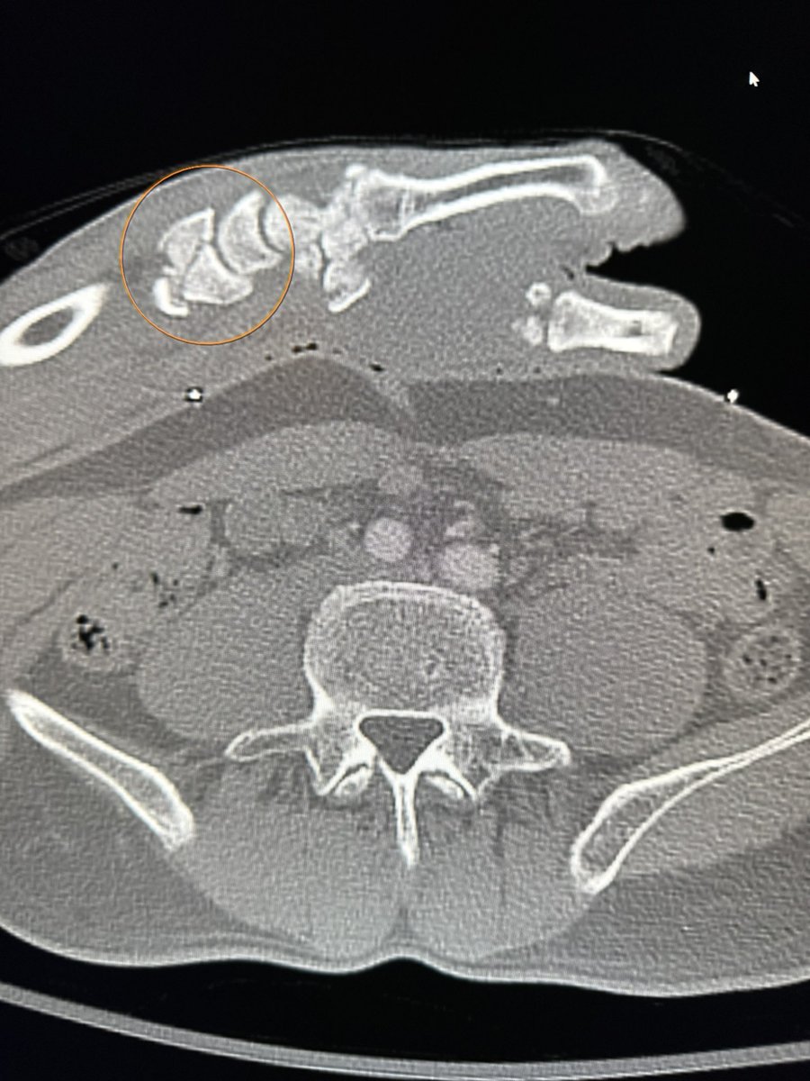 IncidentalMD's tweet photo. CT ab/pel for a trauma, patient couldn’t lower their right hand down for the exam. I wonder why 🤔?

Good reminder to always check everything in the field! https://t.co/sjyVJgaU2p