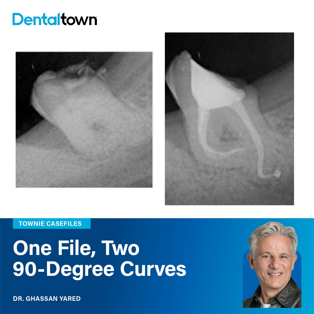 Dentaltown's tweet photo. Dr. Ghassan Yared shaped a mandibular third molar with two 90-degree canal curves using a single reciprocating file, no scouting, no glide path. 
➡️ https://t.co/H4tWrNUR30 
#Dentaltown #Endodontics https://t.co/kjcHAui69Z