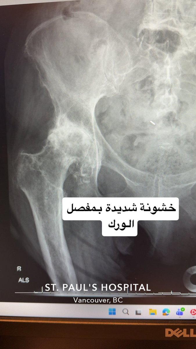Yazeed_q92's tweet photo. حالة نجاح جديدة بفضل الله من هنا 🇨🇦

مريضة تعاني من #خشونة_الورك الشديدة وآلام مزمنة، وترفض فكرة تركيب مفصل صناعي كليًا.

التحدي تمثل بأن حقنة الكورتيزون التقليدية تحت الأشعة لم تعد تجدي نفعًا، حيث استمر مفعول آخر حقنة لمدة 3-4 أسابيع فقط.

تم علاج الألم بنجاح عن طريق الأشعة التداخلية و "كي الأعصاب الحسية للورك".

استغرق الاجراء  نصف ساعة فقط وبتخدير موضعي، لتعود المريضة لحياتها الطبيعية بدون جراحة.

#الأشعة_التداخلية #علاج_الألم