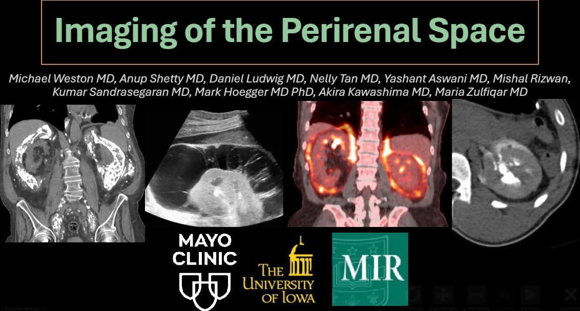 YashantAswani's tweet photo. Accepted manuscript @Radiographics 

'Imaging of perirenal space'
 
@nupedogg @mariazulfiqar14 @yashantaswani @nellytanmd #radiology #radres #radtwitter #kidney #perirenal https://t.co/dCrtRrcOn8