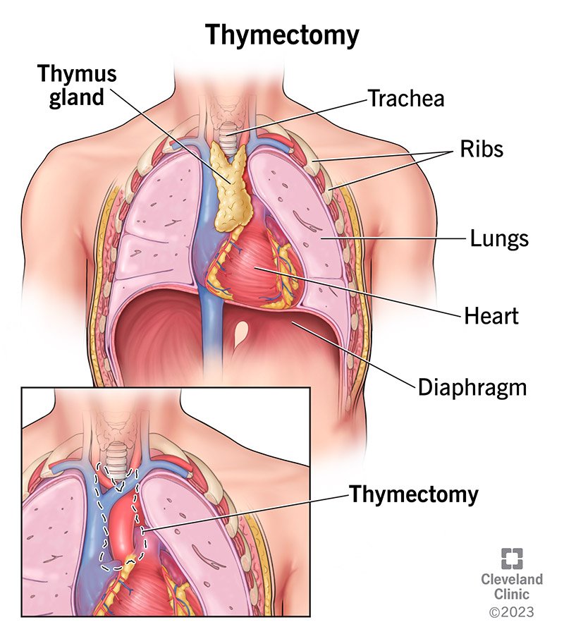 Cosmiceyecare's tweet photo. DID YOU KNOW?

Eye 👁️ health examination can uncover undiagnosed tumours in the chest cavity including tumours of thymus gland such as thymoma & thymic epithelial tumours! 

An eye isn't just a sense organ for sight but actually a physiological health instrument that can uncover what CT scan will actually miss! 

#Kenya 
#EyeHealth
#Myopia