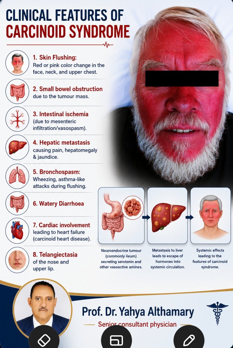 DYahya19's tweet photo. clinical features of carcinoid syndrome https://t.co/MmSM6lY41d