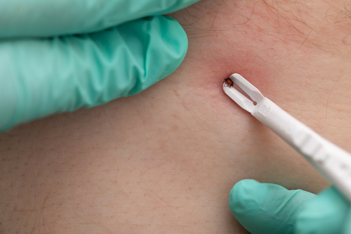 BSEO_tweet's tweet photo. Si vous apercevez une tique sur votre peau, enlevez-la dès que possible. Le risque de contracter la maladie de Lyme ou d’autres maladies transmissibles par les tiques, augmente avec la durée pendant laquelle la tique reste attachée à votre corps. https://t.co/WjIIalUk1T https://t.co/6bOtE8aYJ9
