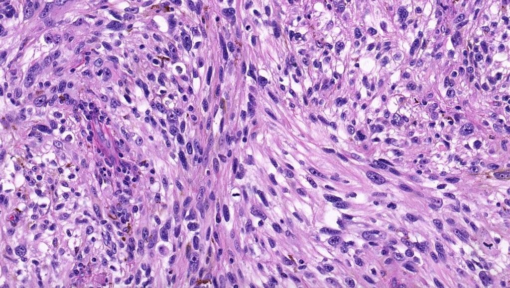 JMGardnerMD's tweet photo. 65 yo man with rapidly growing ulcerated black nodule on back. 
WSI digital slide: https://t.co/9gr4CNWTYX
Answer ✅  https://t.co/5A80donHz0 
#BSTpath #pathology #pathologists #pathTwitter #dermpath #dermatology #dermatologia #dermtwitter https://t.co/ua0whhpnzS