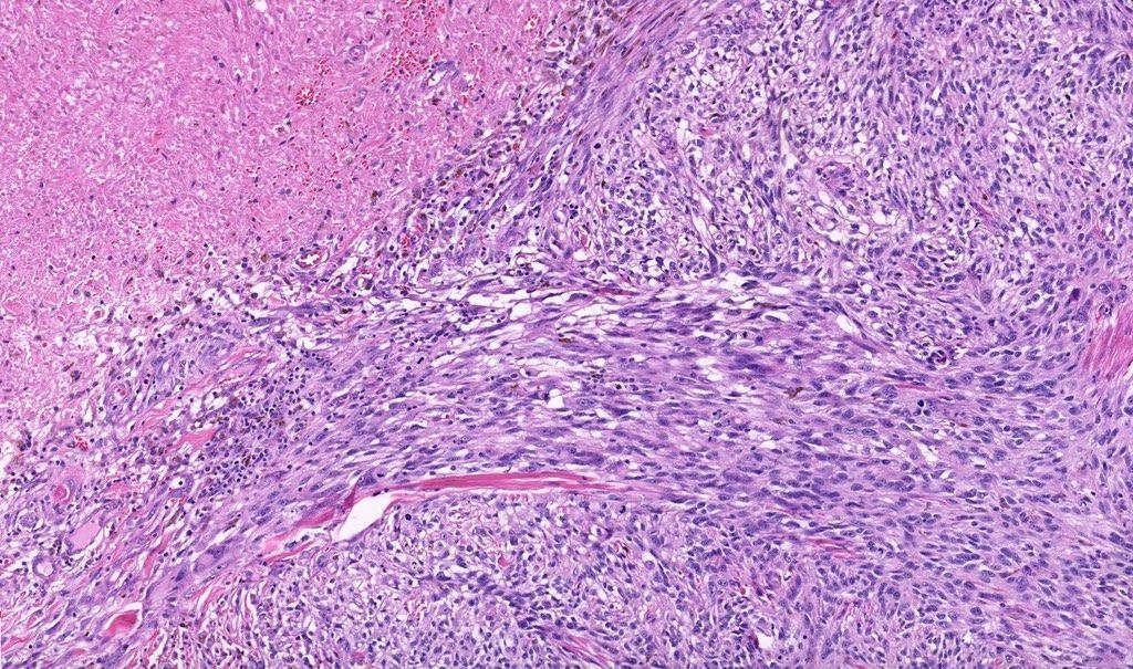 JMGardnerMD's tweet photo. 65 yo man with rapidly growing ulcerated black nodule on back. 
WSI digital slide: https://t.co/9gr4CNWTYX
Answer ✅  https://t.co/5A80donHz0 
#BSTpath #pathology #pathologists #pathTwitter #dermpath #dermatology #dermatologia #dermtwitter https://t.co/ua0whhpnzS