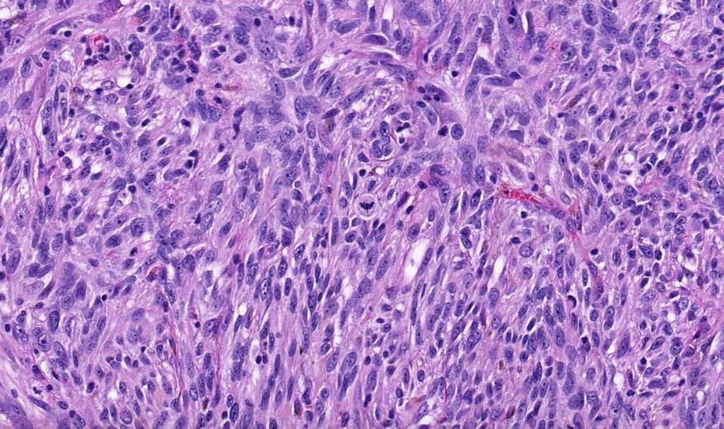 JMGardnerMD's tweet photo. 65 yo man with rapidly growing ulcerated black nodule on back. 
WSI digital slide: https://t.co/9gr4CNWTYX
Answer ✅  https://t.co/5A80donHz0 
#BSTpath #pathology #pathologists #pathTwitter #dermpath #dermatology #dermatologia #dermtwitter https://t.co/ua0whhpnzS