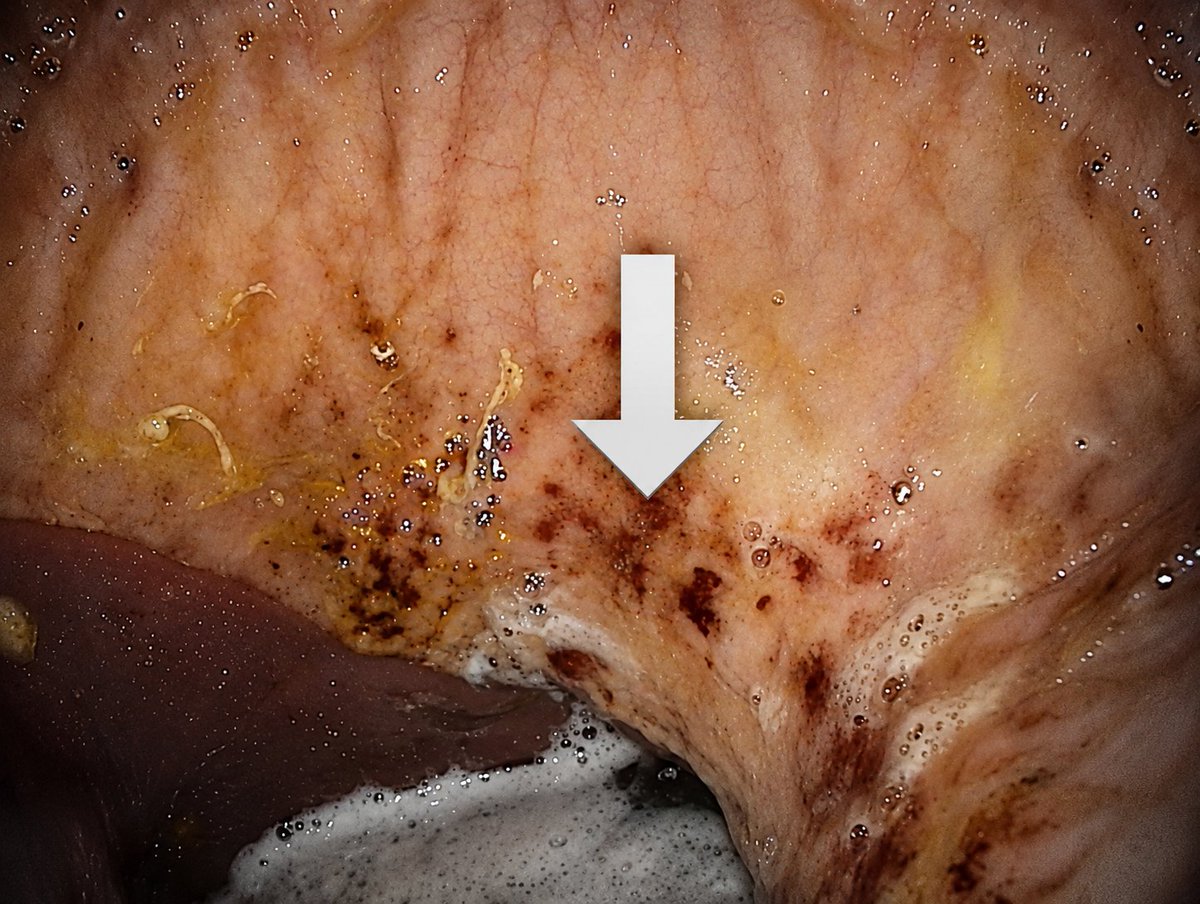 NovickDvm's tweet photo. Did you know gastric ulcers are one of the most common health concerns in horses?
Research estimates that 30–60% of non-race performance horses and up to 89% of racehorses develop gastric ulcers. #horses #equinecare #veterinarian https://t.co/mmd91PfR9C