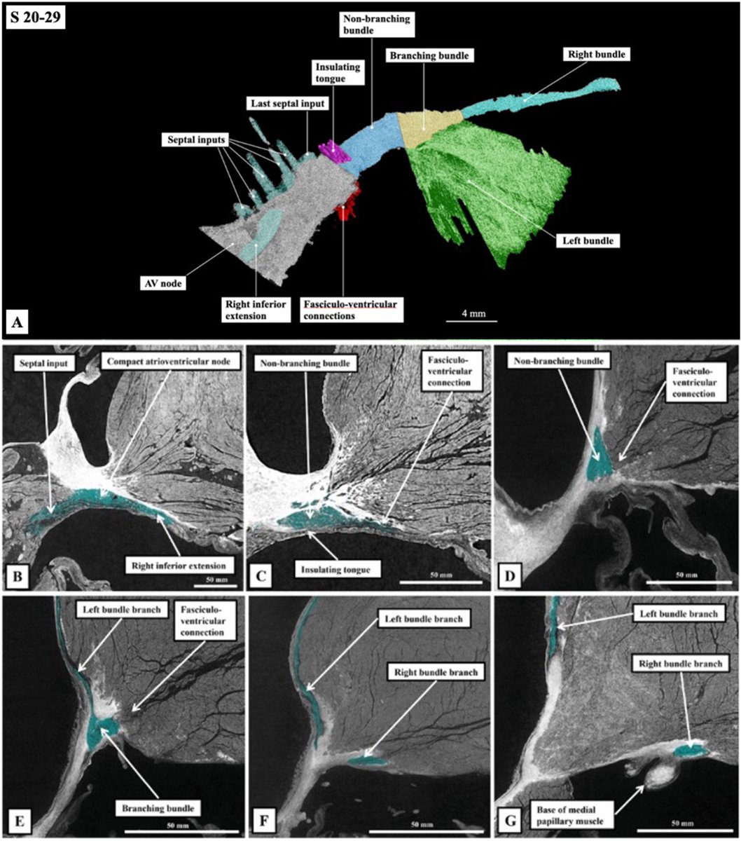 hrs_journal's tweet photo. Unravelling the enigmatic morphology of the atrioventricular conduction axis using Hierarchical Phase-Contrast Tomography (HiP-CT) #OpenAccess 

@Chloe_Li_ @aaalmehandi @UCL_ICS 

https://t.co/YvNpPRyFnL https://t.co/Lm6pzAHlJ3