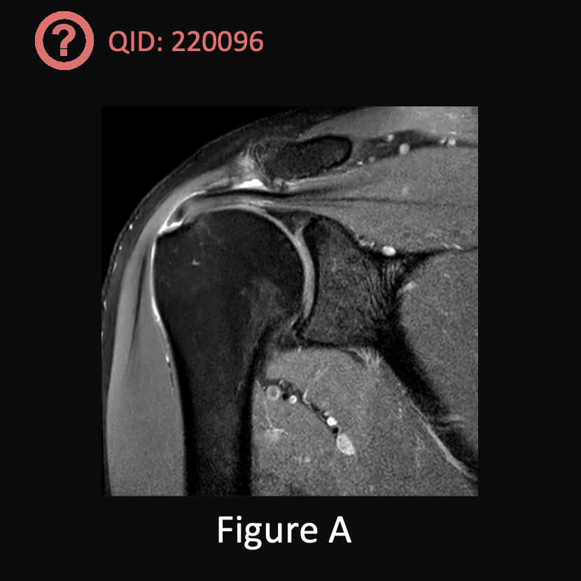 orthobullets's tweet photo. Can you answer our free question of the day?

A 55-year-old nurse presents with recalcitrant shoulder pain despite 3 months of physical therapy and a complete course of non-invasive management. Her MRI shown in Figure A demonstrates a high-grade partial thickness tear of her rotator cuff. Her treating surgeon is planning to perform an arthroscopic surgery involving tear completion and rotator cuff repair. If the red dots in Figures B and C represent medial row anchors and the blue dots represent lateral row anchors, which of the following can be said about the rotator cuff repair construct in Figure C compared to that shown in Figure B?

1. The construct in Figure C results in improved forward elevation and external rotation at long-term follow up

2. The construct in Figure B is more costly than that in Figure C

3. The construct in Figure B results in less post-operative pain and faster recovery

4. The construct in Figure C results in improved healing and lower re-tear rates

5. The construct in Figure B results in less intra-operative blood loss

QID: 220096
Comment your answer below, then check to see if you got it correct by clicking the link below to see the answer & explanation.
https://t.co/5534lnzDxu
#orthopedics #orthopedicsurgeon #orthopaedics #orthopaedic #orthopedic #ortholife #orthobullets #orthoresidents #orthoresident #orthoresidency #medicalschool #medicalstudent #medstudent #doctor