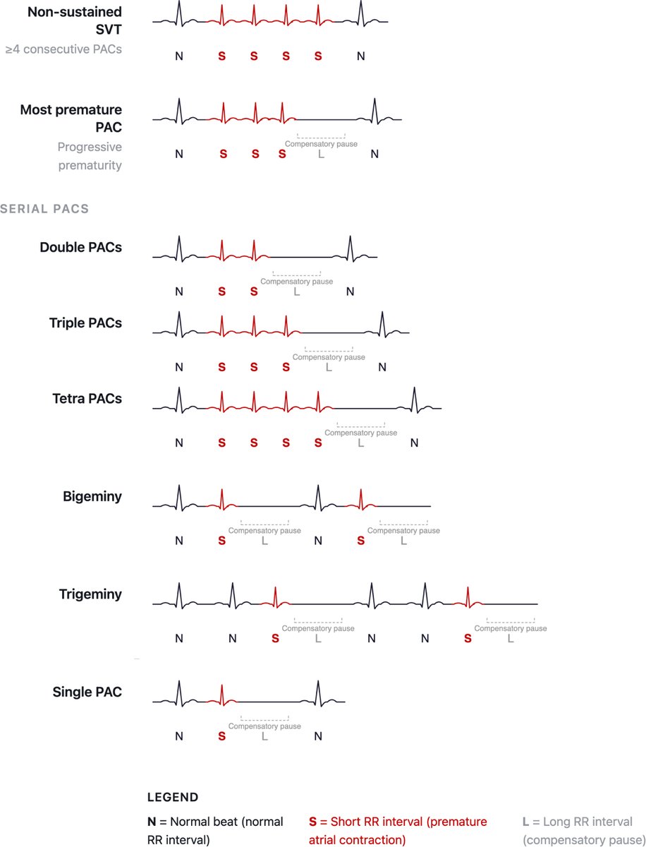 hrs_journal's tweet photo. Supraventricular Arrhythmia Prematurity, and Risk of Incident Atrial Fibrillation #OpenAccess 

https://t.co/RMTjNIn9pr https://t.co/lmH8dSZmGI
