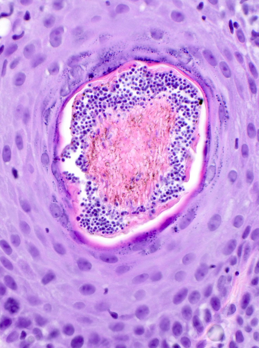 JMGardnerMD's tweet photo. Scalp biopsy. Diagnosis? 
Answer ✅ https://t.co/XnoVMxjWpQ
More pics: https://t.co/sDUgUqZMp3 
Digital slide 🔬 https://t.co/u4Eq6bya25 
#pathology #pathTwitter #dermpath #dermatology #dermatologia #dermtwitter https://t.co/L8VUL0fWFJ