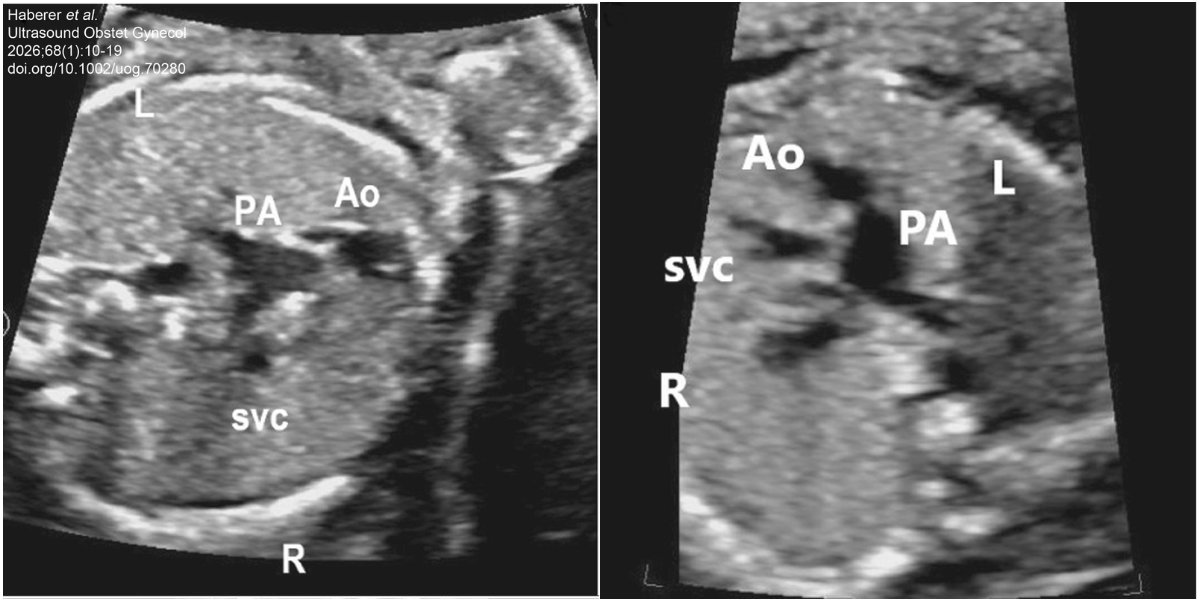 ISUOG's tweet photo. In this five-year nationwide cohort study, Vedel et al. evaluate the Danish prenatal screening program for major fetal congenital heart defects (mCHD), highlighting increased prenatal detection rates and a declining liveborn incidence of mCHD in  Denmark, underscoring the efficacy of a national screening program and centralised care.

Check out the full #openaccess article in the #UOGJournal Special Issue on CHD: https://t.co/uOQSQ5H6Ao

@WileyHealth 

#LoveUltrasound #ISUOG2026 #EveryLittleHeartMatters