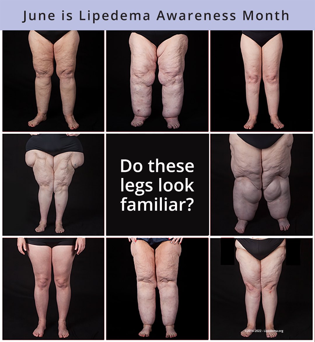 SlapbotG's tweet photo. @AMarjenrose @Gl1tter_Fawn She didn’t say anything abt the girl but the girl is a damn liar, her calfs would also be huge and she would have cellulite like crazy if she had lipodema, plus she has no fat on her waist. Here’s what real lipodema looks like https://t.co/CjBPR9jpap