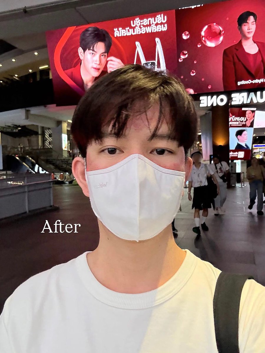 jay_thvnkrn's tweet photo. 📌 หลังทำ pico laser เสร็จ ควรใส่แมส แล้วให้รีบกลับไปพักหน้าที่บ้าน

ไม่แปลกใจที่บางคน หน้าอักเสบ เป็นหนอง มีรอยดำ เพราะหลังทำเสร็จเขาไม่ใส่แมสเลย

เดินเล่นแบบหน้าเปลือย ต่อให้เป็นในห้างก็ไม่ควร เพราะทุกที่มีฝุ่น ควัน

✅ หลังทำก็ควรดูแลรักษาตามนี้ครับ
1. ไม่ล้างหน้าใน 24 ชม. เพราะแผลยังสด
2. ครบ 24 ชม. ล้างหน้าด้วยน้ำสะอาด/น้ำเกลือ 1-2 วันต่อจากนั้น
3. เมื่อแผลเริ่มแห้ง ตกสะเก็ดแล้ว จะล้างด้วยโฟมที่อ่อนโยน/สบู่เด็ก ลดการระคายเคือง
4. เริ่มทากันแดดเมื่อแผลแห้งสนิท ไม่งั้นจะอุดตัน ทำความสะอาดยาก
5. ทากันแดดและใส่แมสจนกว่าผิวจะกลับมาแข็งแรง (แต่กันแดดต้องทาทุกวันนะครับ)