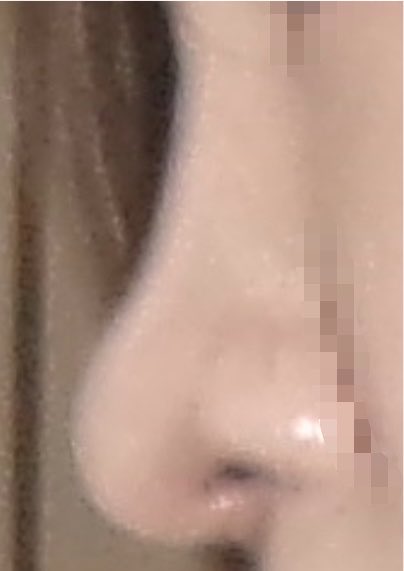 nbddly33's tweet photo. 鼻フルから半年が、たちました！顔になじみ、浮腫もでにくくなりました
今のところ大きく後戻りしている様子もないです
経過観察続けていきます😆

#アウラ美容整形外科 #チュ先生 https://t.co/A4SNWAR6aK