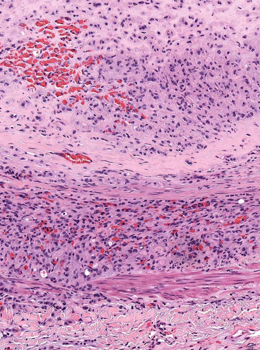 JMGardnerMD's tweet photo. 30 F. Mass in lumen of femoral vein. Diagnosis?
Answer ✅ https://t.co/YUOdqYSNMx 
Digital slides: https://t.co/7EGBShOiOG 
Immunostains: https://t.co/E6Yrd12tRa
#pathology #pathologists #pathTwitter #dermpath #dermatology #dermatologia #dermtwitter #BSTpath https://t.co/IAZDGODHYQ