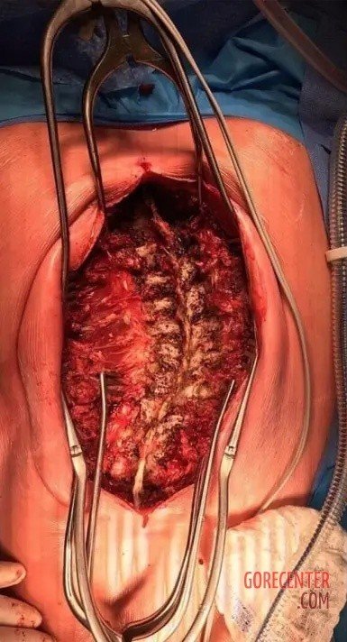 Headnurses's tweet photo. This looks so cool, this is how a spine looks like with Scoliosis!
!!NONE OF THESE R MINE AND THEY ARE ALL FAKE AND MADE WITH AI TRUST ME!!
#scoliosis #hospital #fake #goretwt https://t.co/NXjGDyaJvO