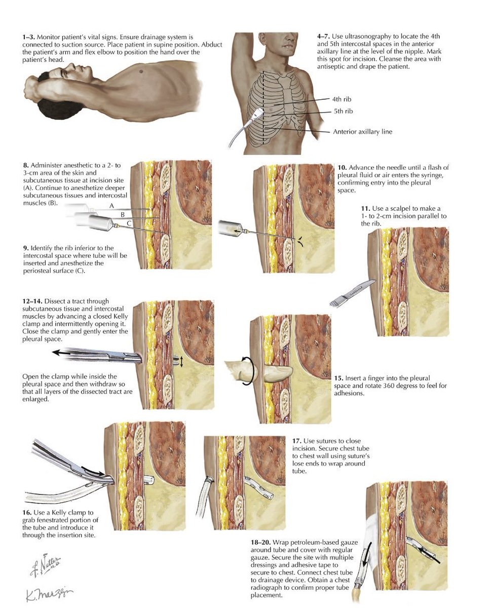 TrackYourHeart's tweet photo. Chest Tube Insertion: Step-by-Step Guide https://t.co/zJYkR2l8BL