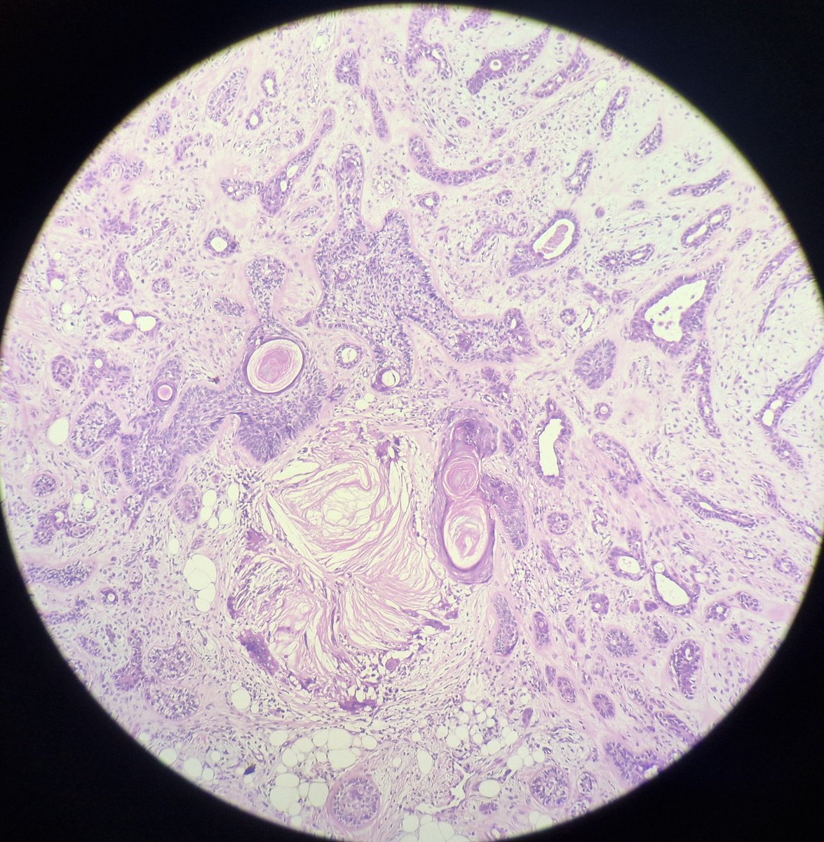 arthy_os's tweet photo. 71/M, 2x2 cm lesion, left nasal roof, M- dermis show well circumscribed, unencapsulated,  biphasic tumor,branching tubular epithelial cells, keratinous cysts with infundibular keratinisation,  stroma with chondroid ,  osseous and adipocytic metaplasia.Diag- CHONDROID SYRINGOMA https://t.co/LoyOwMASgQ