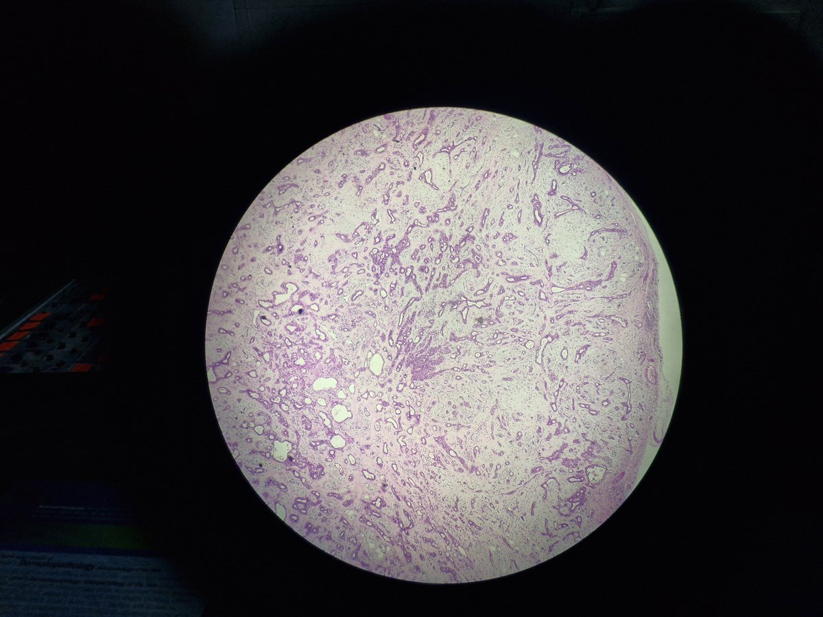 arthy_os's tweet photo. 71/M, 2x2 cm lesion, left nasal roof, M- dermis show well circumscribed, unencapsulated,  biphasic tumor,branching tubular epithelial cells, keratinous cysts with infundibular keratinisation,  stroma with chondroid ,  osseous and adipocytic metaplasia.Diag- CHONDROID SYRINGOMA https://t.co/LoyOwMASgQ