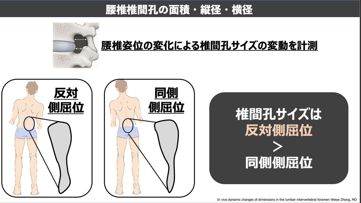 mori_pt_gbc's tweet photo. 椎間孔サイズの変化についてまとめました。
前弯、後弯、側屈、回旋です。
椎間孔狭窄の治療において必須の知識だと考えています。 

セミナー参加はこちらから      https://t.co/m6jgBd9tY4 https://t.co/nJUVRNAecH