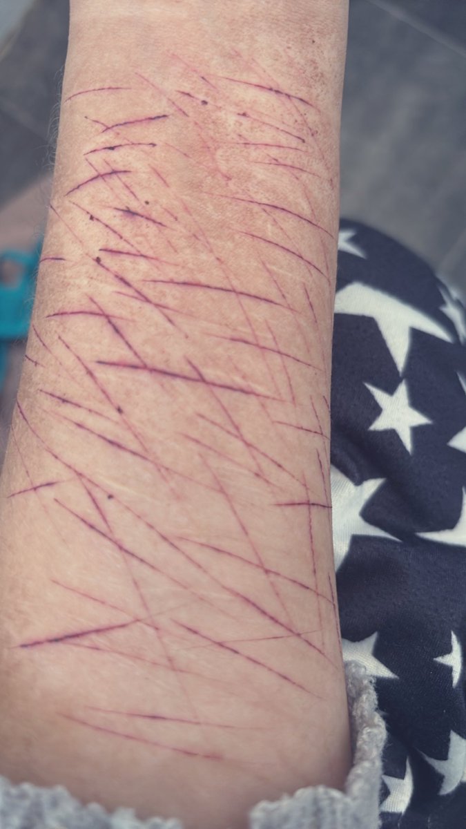 nutmaster999's tweet photo. slash flash before i finally get in the shower 🥺 they look so pretty the day after 🤤 whyis my blood purple https://t.co/SBb8giRJwl