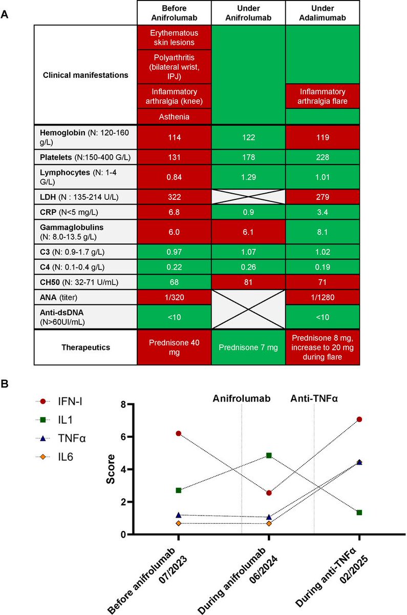 bmj_rmdopen's tweet photo. 🧬 First report of anifrolumab in ADA2 deficiency (DADA2)
👩 26-year-old initially diagnosed as SLE; atypical features (hypogammaglobulinaemia, B-cell lymphopenia, vanishing anti-dsDNA)
🧪 Homozygous class 5 missense CECR1/ADA2 variant confirmed DADA2
📉 Anifrolumab (anti-IFNAR1) induced rapid remission + major corticosteroid tapering
💡 Lower type I IFN score under anifrolumab — positions DADA2 near the type I interferonopathies

🔗 https://t.co/B9DgsFzfhR