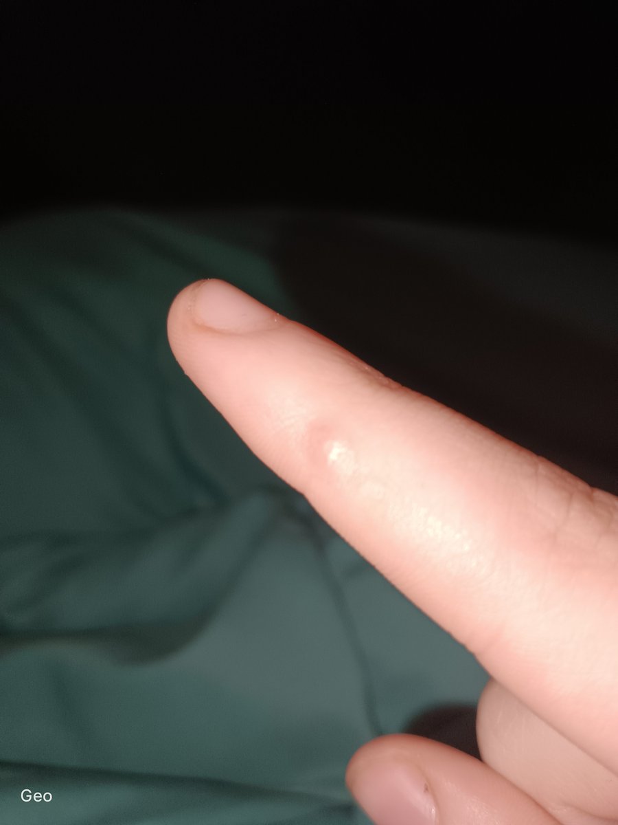 FowlerGeor59926's tweet photo. @Human_F4ilure I think I have this too? I only get it on my pointer finger, started off like a callous but ripped it off and now looks like blister but doesn't really hurt, air filled https://t.co/xLunNMmbSH