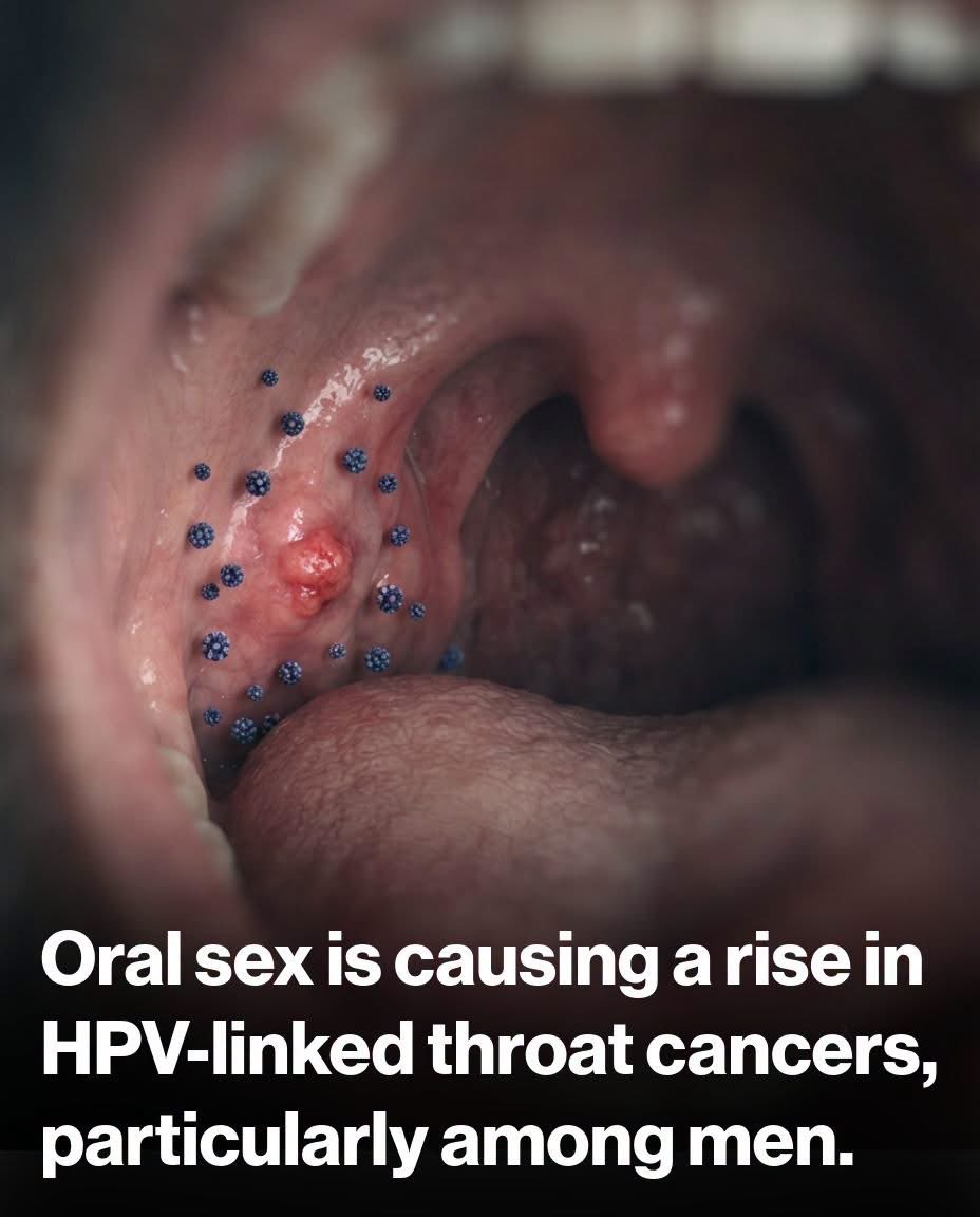 ShiningScience's tweet photo. Human papillomavirus (HPV), a common sexually transmitted infection, has emerged as a leading cause of oropharyngeal cancers affecting the back of the throat, base of the tongue, and tonsils. 

These cancers, once primarily linked to tobacco and alcohol use, are now increasingly driven by HPV transmission through oral sex. 

The virus spreads when infected genital areas contact the mouth or throat during sexual activity, allowing high-risk strains like HPV-16 to infect oral tissues. 

Over years or decades, persistent infections can trigger cellular changes leading to malignancy. Incidence has risen notably since the 1980s, particularly among men, who account for over 80 percent of cases in the United States. 

About 10 percent of men carry oral HPV compared to 3.6 percent of women, reflecting differences in immune response and sexual behaviors. 

Factors such as multiple oral sex partners, earlier initiation of such activity, and higher numbers of lifetime partners significantly elevate risk. 

This shift coincides with broader changes in sexual practices over recent decades, resulting in HPV surpassing traditional causes for throat cancers in many developed nations. 

Men in their 50s and 60s, often without smoking histories, now represent a growing patient group as the virus's long latency period manifests.

While most HPV infections clear naturally, persistent cases underscore the importance of prevention through vaccination before sexual activity begins. 

Regular dental checkups can aid early detection, though symptoms like persistent sore throat or lumps often appear late. Public health efforts focus on awareness to curb this trend.

Source: Centers for Disease Control and Prevention (CDC) - HPV and Oropharyngeal Cancer.