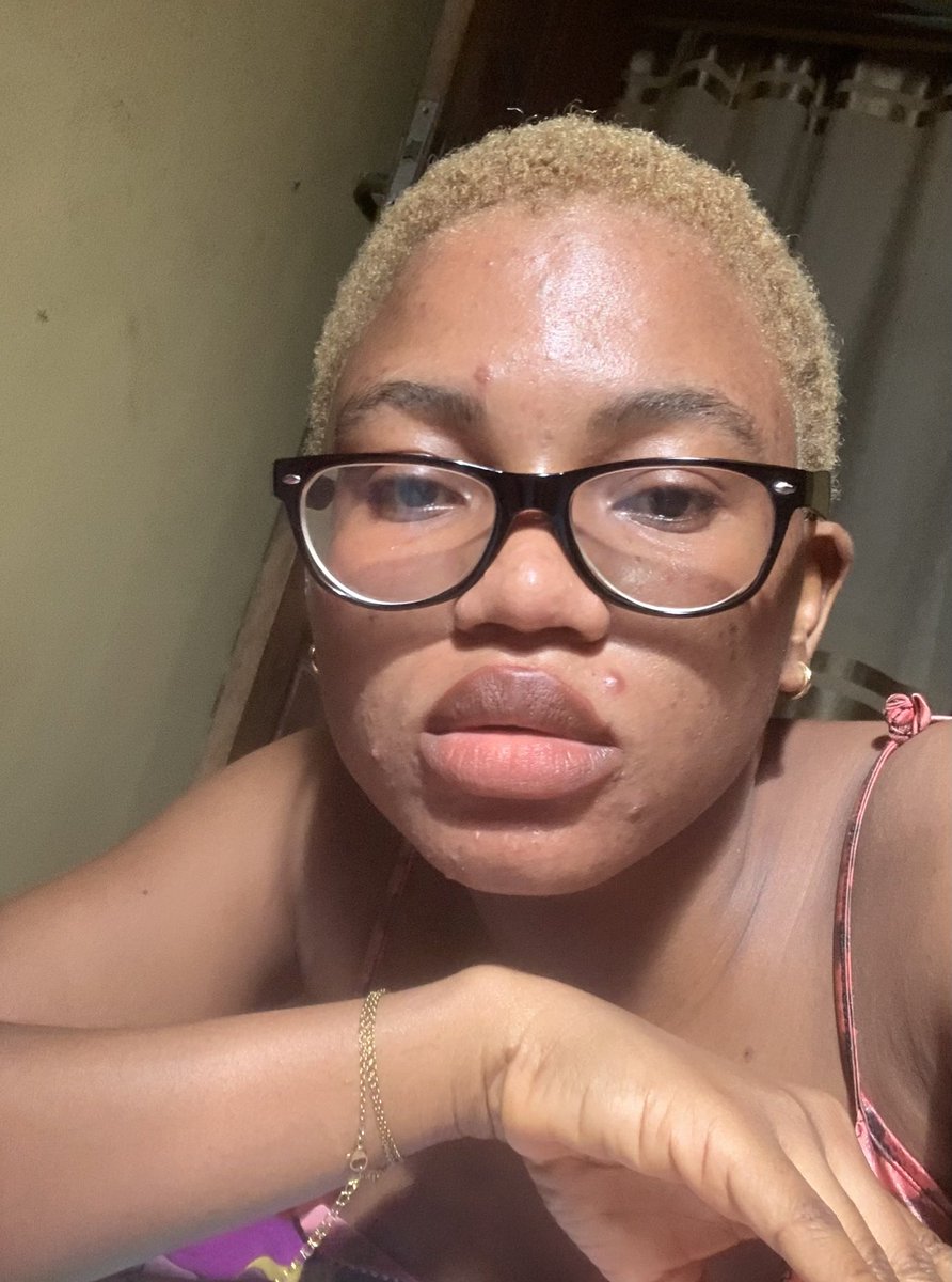 Iamkrebkira's tweet photo. When I feel like I’m getting my glow back and then boom! Hormonal acne strikes again 💔 https://t.co/mKwcT2yhoW