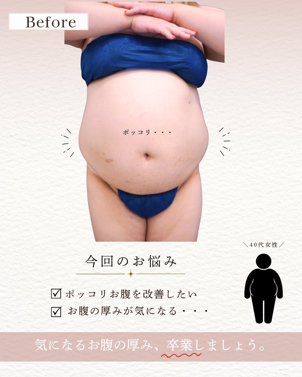 GardenClinicNet's tweet photo. 40代女性：術後2ヶ月 
施術内容：お腹の脂肪吸引 
注意事項：腫れ、浮腫み、内出血 
●1部位 部分モニター220,000円 
●アキーセル1部位 通常料金+55,000円 
●VASER1部位 通常料金+55,000円 
↓脂肪吸引の詳細はこちらをチェック 
 https://t.co/4uppQUdJO4 https://t.co/2X6c1kya6y