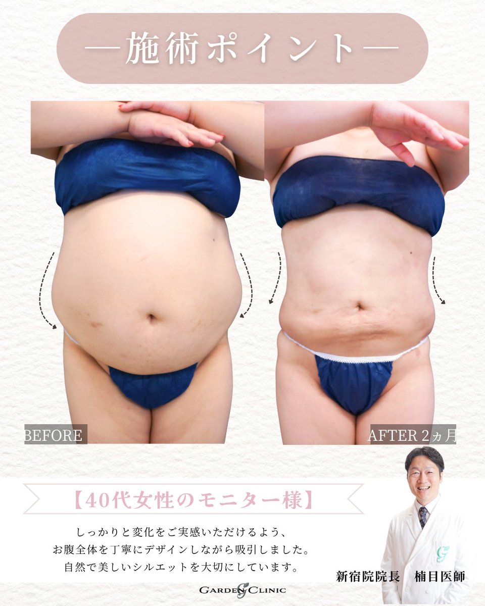 GardenClinicNet's tweet photo. 40代女性：術後2ヶ月 
施術内容：お腹の脂肪吸引 
注意事項：腫れ、浮腫み、内出血 
●1部位 部分モニター220,000円 
●アキーセル1部位 通常料金+55,000円 
●VASER1部位 通常料金+55,000円 
↓脂肪吸引の詳細はこちらをチェック 
 https://t.co/4uppQUdJO4 https://t.co/2X6c1kya6y