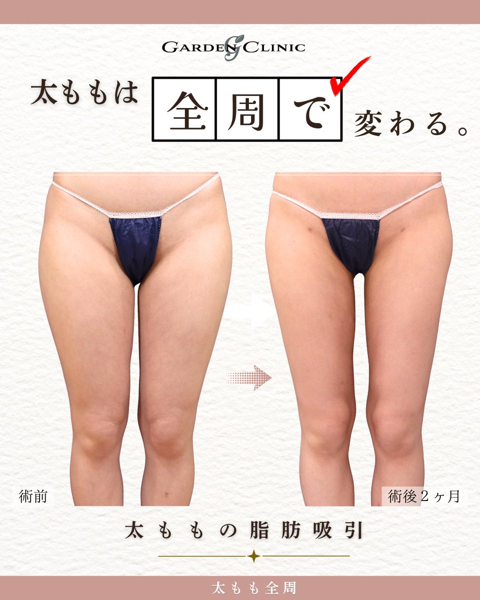 GardenClinicNet's tweet photo. 20代女性：術後2ヶ月 
施術内容：太腿の脂肪吸引
注意事項：腫れ、浮腫み、内出血 
●1部位 部分モニター220,000円 
●アキーセル1部位 通常料金+55,000円 
●VASER1部位 通常料金+55,000円 
↓脂肪吸引の詳細はこちらをチェック
 https://t.co/4uppQUdJO4 https://t.co/G9XDCnt2sd