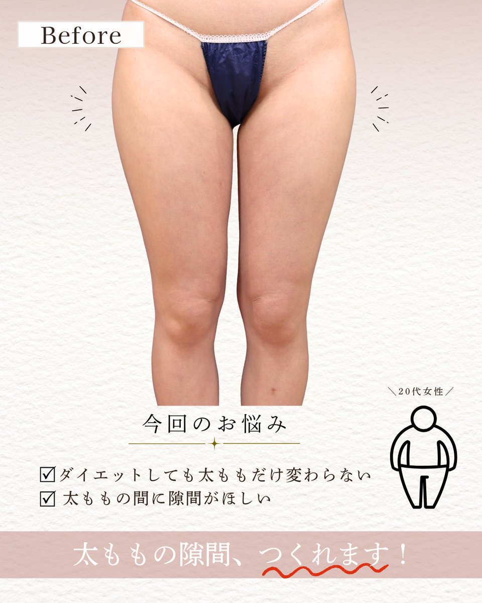 GardenClinicNet's tweet photo. 20代女性：術後2ヶ月 
施術内容：太腿の脂肪吸引
注意事項：腫れ、浮腫み、内出血 
●1部位 部分モニター220,000円 
●アキーセル1部位 通常料金+55,000円 
●VASER1部位 通常料金+55,000円 
↓脂肪吸引の詳細はこちらをチェック
 https://t.co/4uppQUdJO4 https://t.co/G9XDCnt2sd