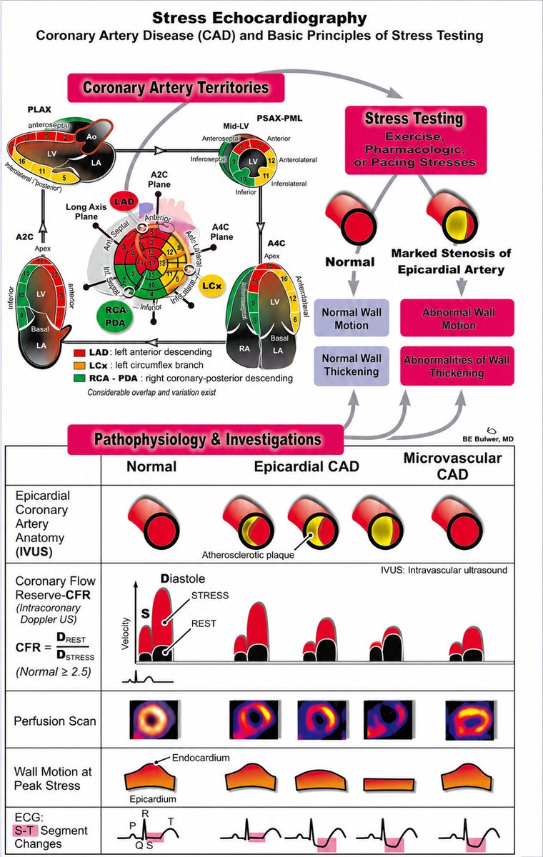 TrackYourHeart's tweet photo. Stress Echocardiography: A Comprehensive Guide.
Credit: BE bulwer, MD https://t.co/ltjpliEZYF