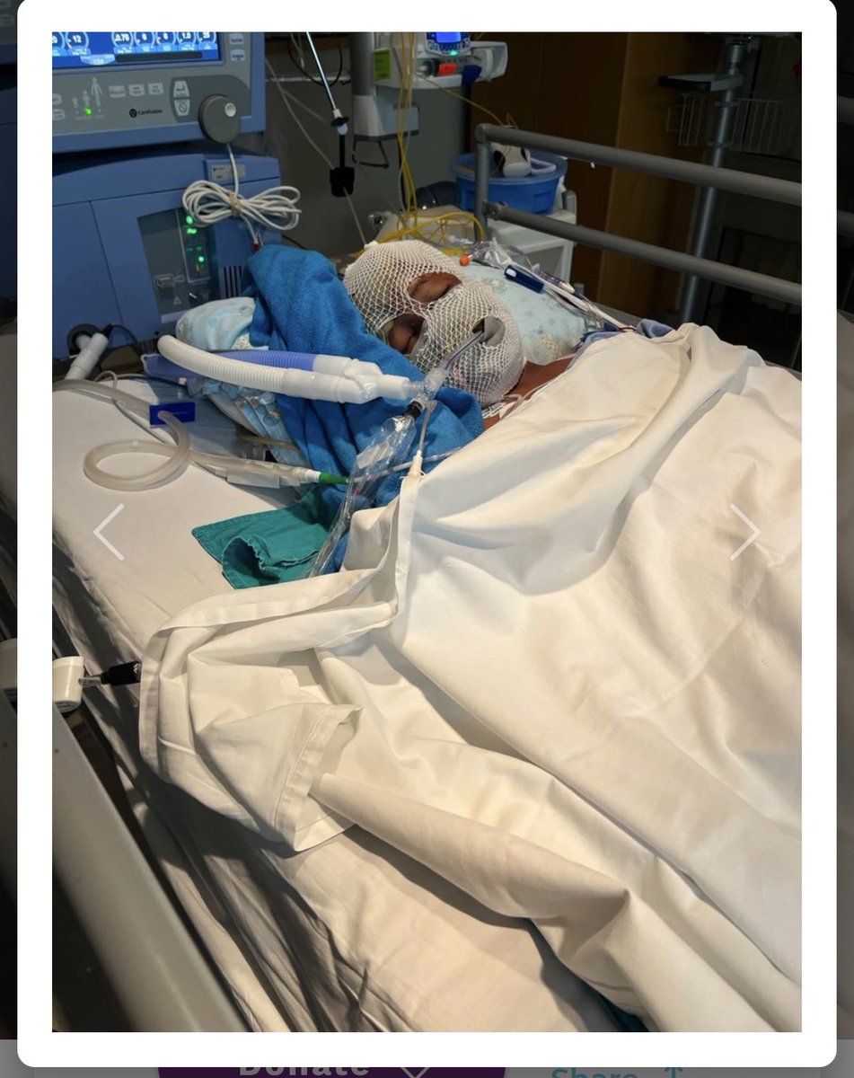 Lee_Raa_Tuu's tweet photo. Nnete Leotlela: BackaBuddy Raises R112,785 for Boy Mauled by 5 Dogs in Maseru 

A 12-year-old boy is fighting to recover in an intensive care unit after sustaining devastating injuries when five German Shepherds attacked him at a residential property in Ha Abia, Maseru, on 6 July. 

Nnete Leotlela had gone to collect his younger brother from aftercare when he rang the intercom at what turned out to be the wrong address. After walking inside, the five dogs set upon him, leaving him with injuries that include the loss of both ears and his lower lip, as well as extensive scalp damage. 

His aunt, Maiketso Titisi, described his condition as stable, noting that Leotlela is communicating through writing while receiving physiotherapy and psychological support. Despite recurring flashbacks and severe trauma, she said he continues to cooperate with medical staff and display remarkable resilience.
 
𝐁𝐚𝐜𝐤𝐚𝐁𝐮𝐝𝐝𝐲 𝐜𝐚𝐦𝐩𝐚𝐢𝐠𝐧 𝐠𝐚𝐢𝐧𝐬 𝐦𝐨𝐦𝐞𝐧𝐭𝐮𝐦
Campaign organiser Limpho Tsasanyane launched the fundraiser to relieve financial pressure on the family as their medical aid funds approach exhaustion. As of the latest update, the global BackaBuddy campaign has collected R112,785 towards a R500,000 target, with more than 180 donors having contributed. 

Supporters Ntebaleng Leluka and Shantell Tswatswa were among those who left messages of prayer and encouragement on the platform. The family intends to use the donations to cover a series of upcoming surgeries aimed at addressing Leotlela's physical, mental, and psychological recovery needs. 

𝐅𝐚𝐦𝐢𝐥𝐲 𝐩𝐥𝐚𝐧𝐬 𝐭𝐨 𝐥𝐚𝐲 𝐜𝐡𝐚𝐫𝐠𝐞𝐬 𝐚𝐠𝐚𝐢𝐧𝐬𝐭 𝐝𝐨𝐠 𝐨𝐰𝐧𝐞𝐫
Titisi confirmed that the family plans to file charges against the owner of the property where the attack occurred. No further details about the owner or any prior engagement with authorities have been confirmed at this stage. Before the incident, Leotlela was an active and ambitious child who enjoyed basketball, reading, and cooking. He has ambitions to become a biochemist. 

The BackaBuddy campaign remains open, and the family is appealing to the public to continue contributing as the boy's treatment is expected to be lengthy and costly. His lower lip was injured in the attack and is currently receiving treatment in an intensive care unit.