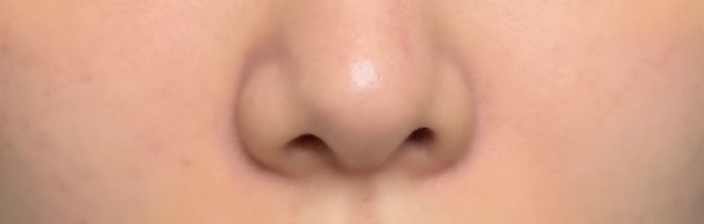 re_s2a's tweet photo. シンサエル整形外科さんで目の下脂肪再配置+脂肪注入、ほうれい線脂肪注入をして約6ヶ月が経過しました！
写真は1、2枚目が現在、3、4枚目が術前です。

脂肪注入のリタッチから3ヶ月経過し、馴染みました！
コンプレックスだったクマがかなり改善したのがすごくうれしいです🥹 https://t.co/QGUN5QfLf3