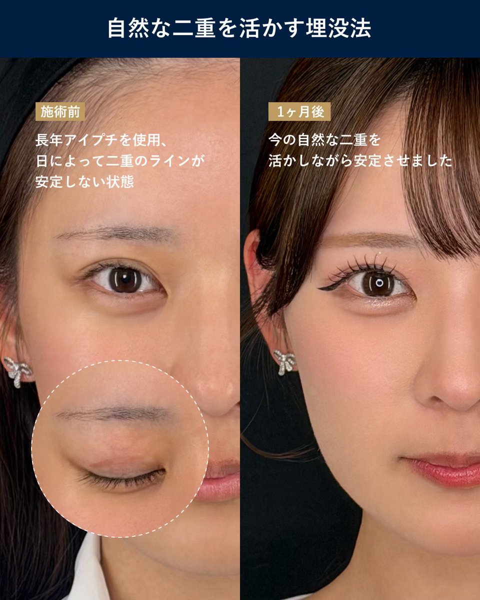 vclinic_jp's tweet photo. LAST CALLで活躍中の星乃リアさん（@_hoshino_ria_ ）にご来院いただきました🌷

【施術内容】
・顎下脂肪吸引
・二重埋没法
執刀：今田医師

今田医師のこだわりは「その方に本当に必要な施術だけをご提案すること」🌸

頬はあえて残す選択で星乃リアさんらしい柔らかさをキープ✨

▼予約はプロフィールURLから
@vclinic_jp