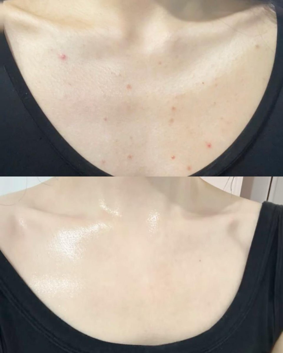 ru9kchan's tweet photo. 背中もだけど、胸元ぶつぶつ民にも推したい🥹デコルテのざらつきが気にならなくなって、かなりお気に入り https://t.co/6vlqgX24BX