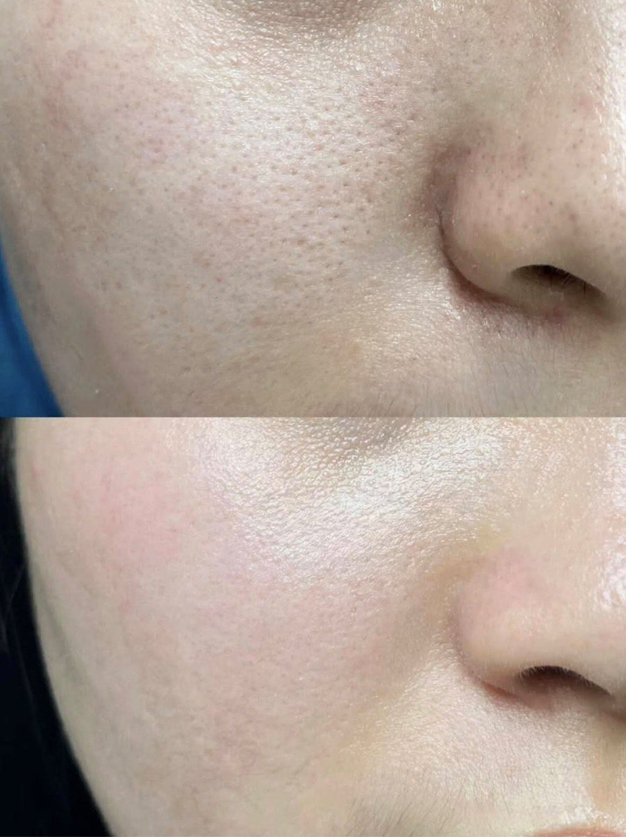 lereeng's tweet photo. PLEASE… ini cleanser enak banget dipake buat yang lagi berjuang sama pori pori &amp; tekstur 😭 https://t.co/oIrpll9bfw