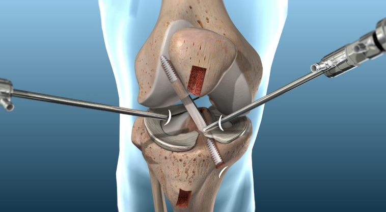 PINESorg's tweet photo. What can athletes do nutritionally to recover well from ACL repair? This article looks at the potential role of protein, creatine, collagen, omega-3s, and other supplements. #Open Access
https://t.co/mPj6351OIk https://t.co/wJY8FAny6Y