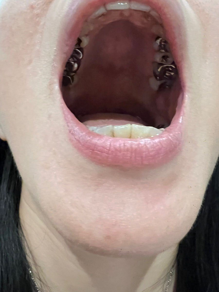 Intraoral_TX's tweet photo. こんばん歯〜実は数日間ザップモールさんのサーバーがダウン致しまして今もう無事に復旧致しましたので
お詫び申し上げます。恐縮です‥

https://t.co/1Gci6qQ3CV

#歯科治療 #口腔 #虫歯 https://t.co/ToNIXxYTIB
