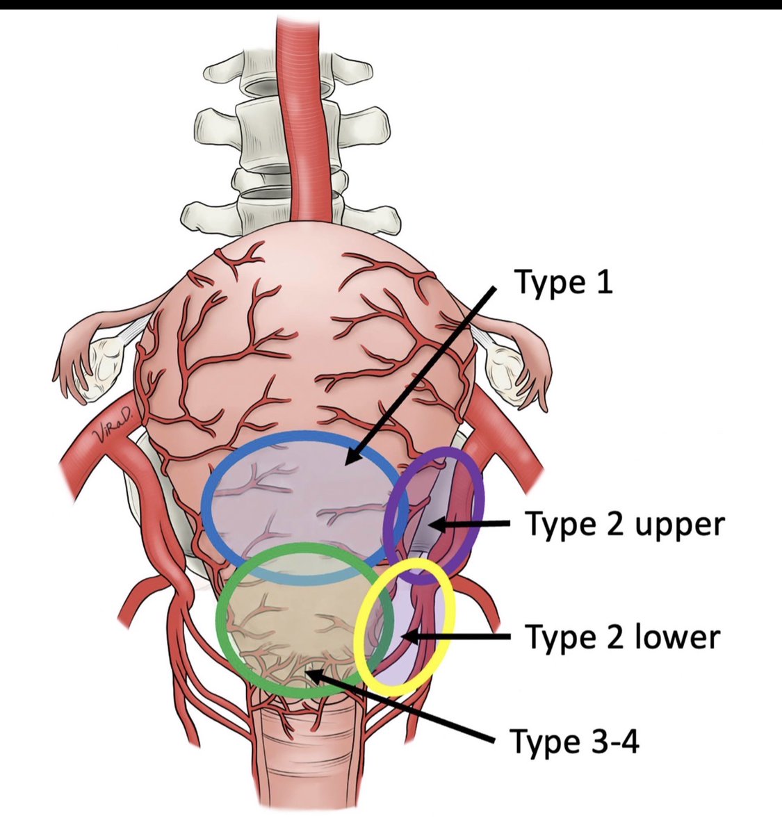 AJOG_thegray's tweet photo. Diagnostic ultrasound to inform the surgical approach to cesarean delivery in patients at high risk for placenta accreta spectrum disorders - Schematic diagram of uterus with topographic classification of lesion location. https://t.co/NzYS1xK8zB https://t.co/T85yfzy9pl