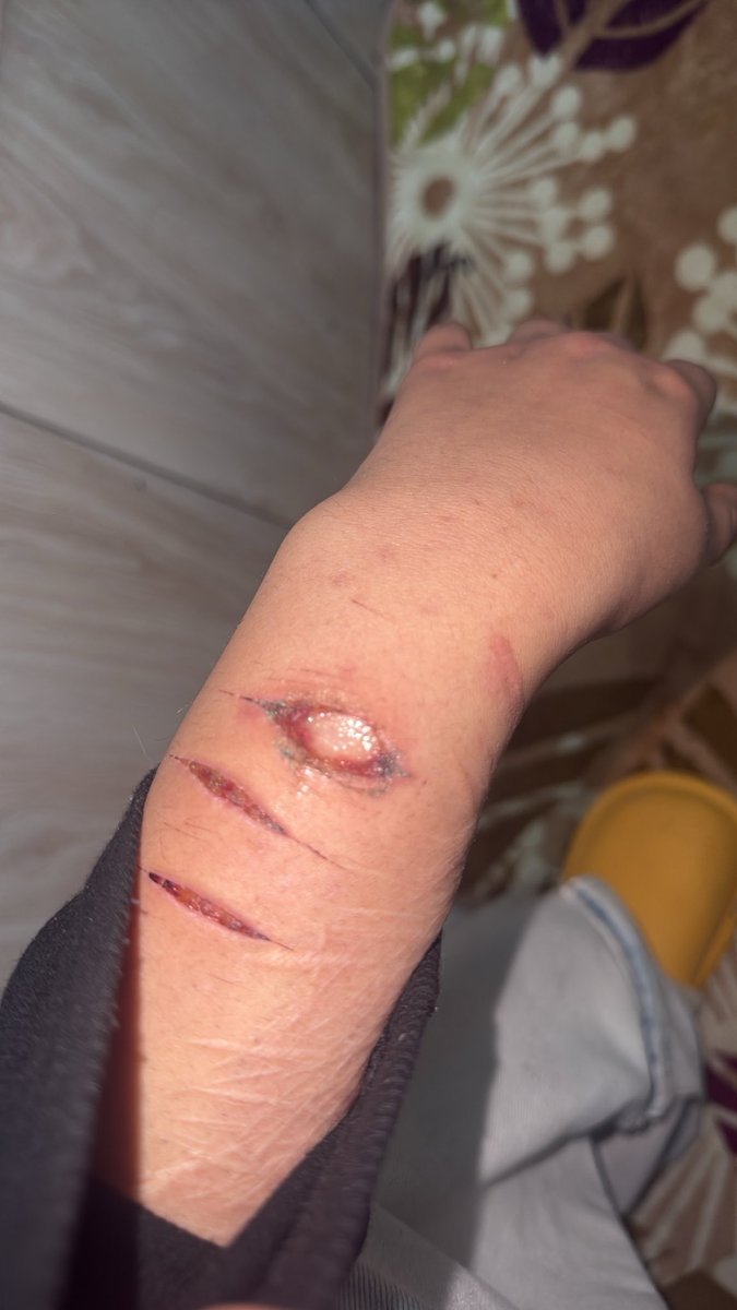 mumsomii's tweet photo. IS THIS INFECTED
FAKE FAKE FAKE
SFX STAGE MAKEUP 
idk
#shtwt #answers #beanstwt https://t.co/OhDW9szLxn